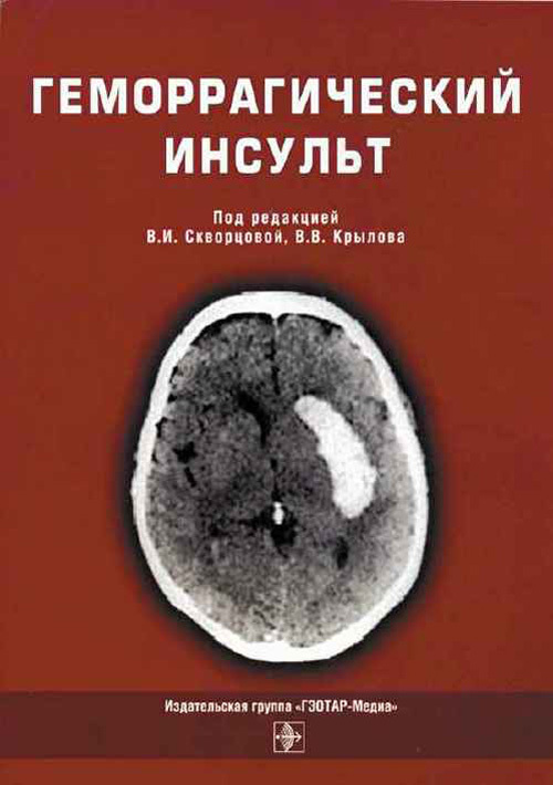 Геморрагический инсульт