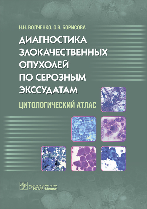 Диагностика злокачественных опухолей по серозным экссудатам