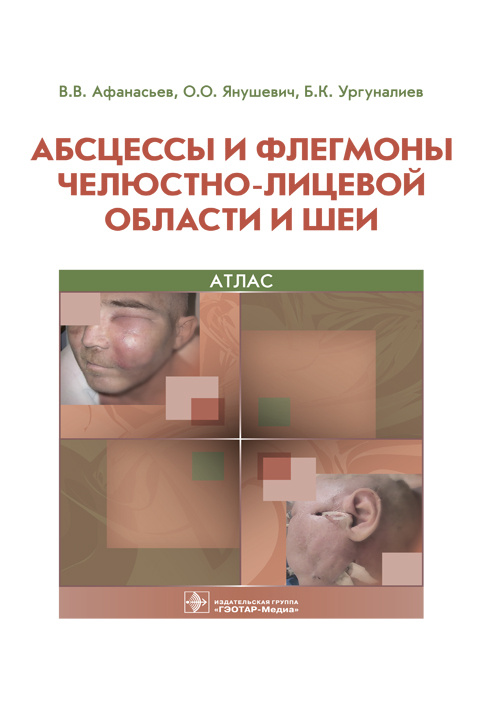 Абсцессы и флегмоны челюстно-лицевой области и шеи. Атлас