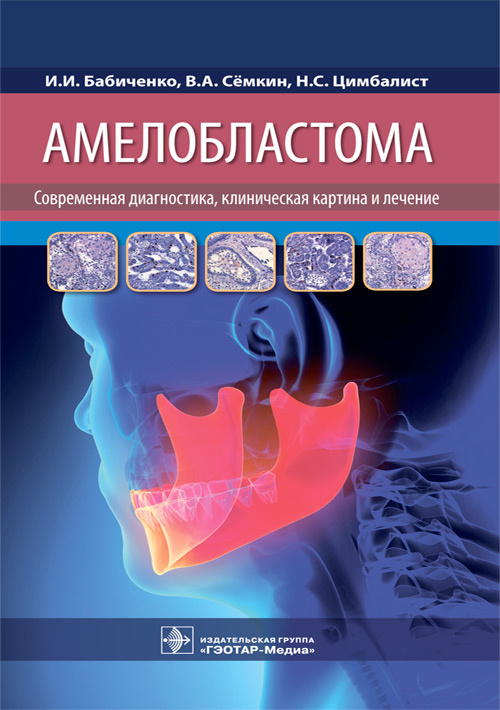 Амелобластома: современная диагностика, клиническая картина и лечение