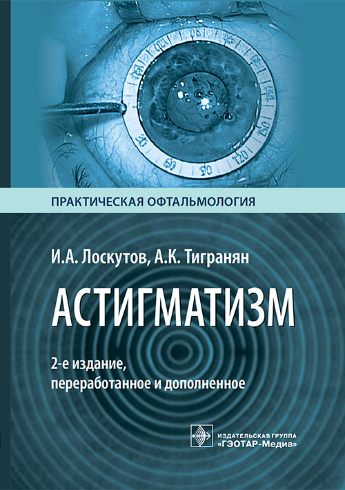 Астигматизм