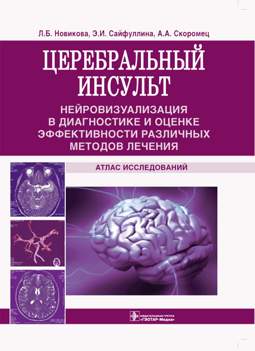 Церебральный инсульт
