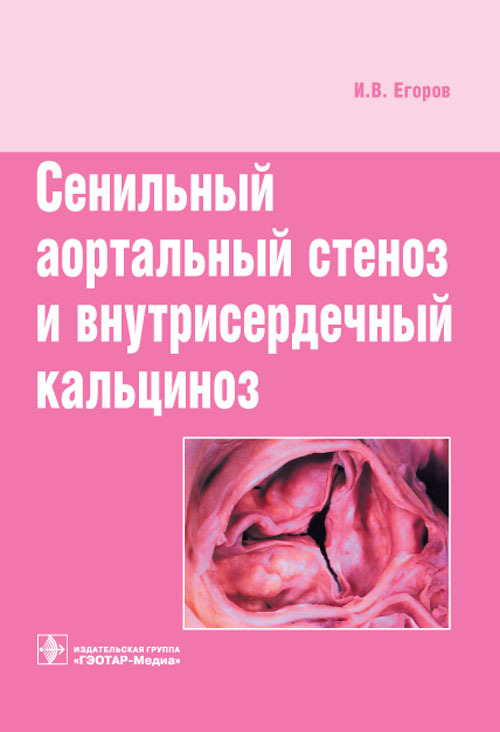 Сенильный аортальный стеноз и внутрисердечный кальциноз